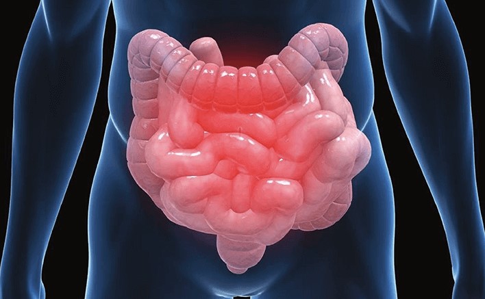 大腸癌是甚麼