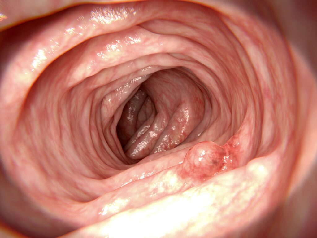 大腸瘜肉